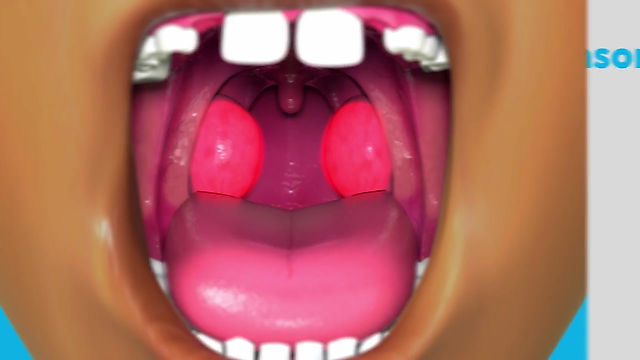 Tonsils and Adenoids Surgery